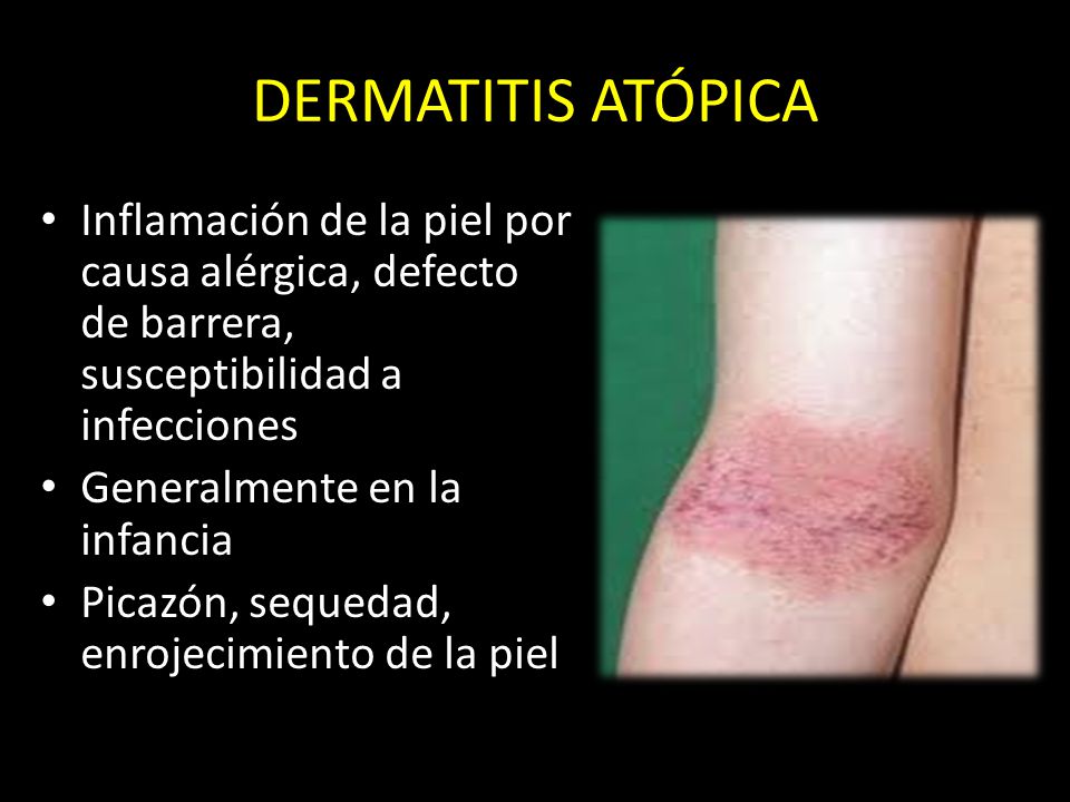 El régimen para la psoriasis del menú